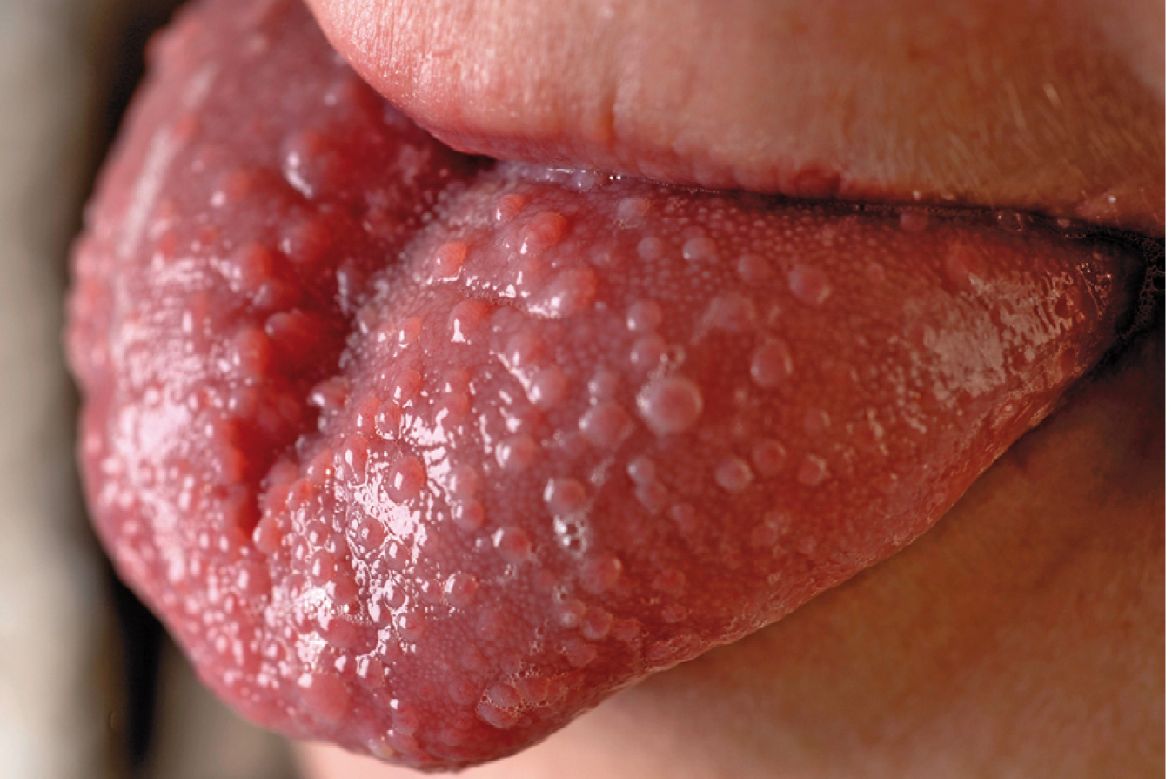 Herpes Type 2 Primary Photos - Dermatology Education