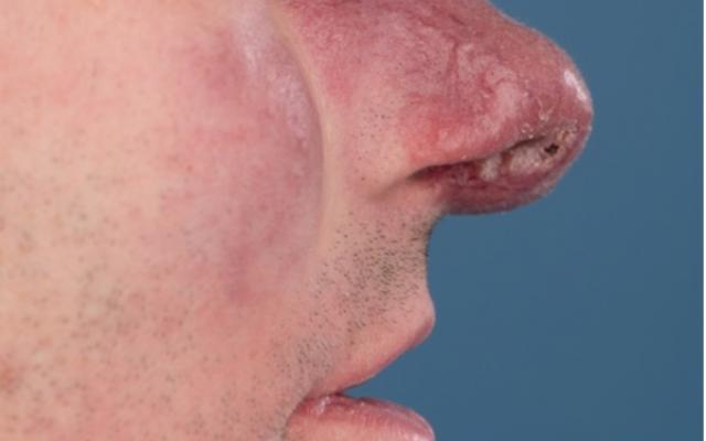 Foto ‘en profile’ van de neus van een 42-jarige man met sinds 8 maanden een pijnloze, progressieve huidafwijking op zijn neus.