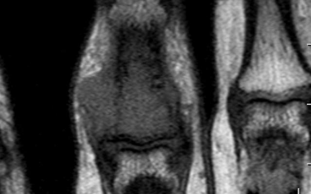 MRI-scan van de ringvinger.