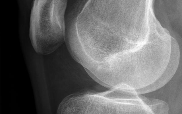 Röntgenfoto van de knie.