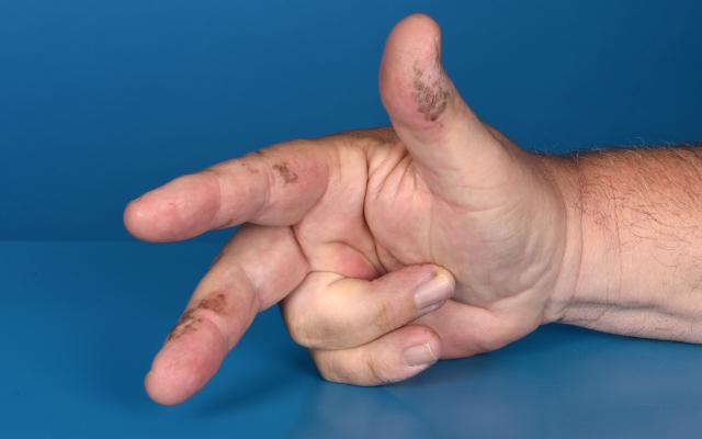Een rechterhand die duim-, wijs- en middelvinger uitsteekt waar bruine vlekken op te zien zijn.