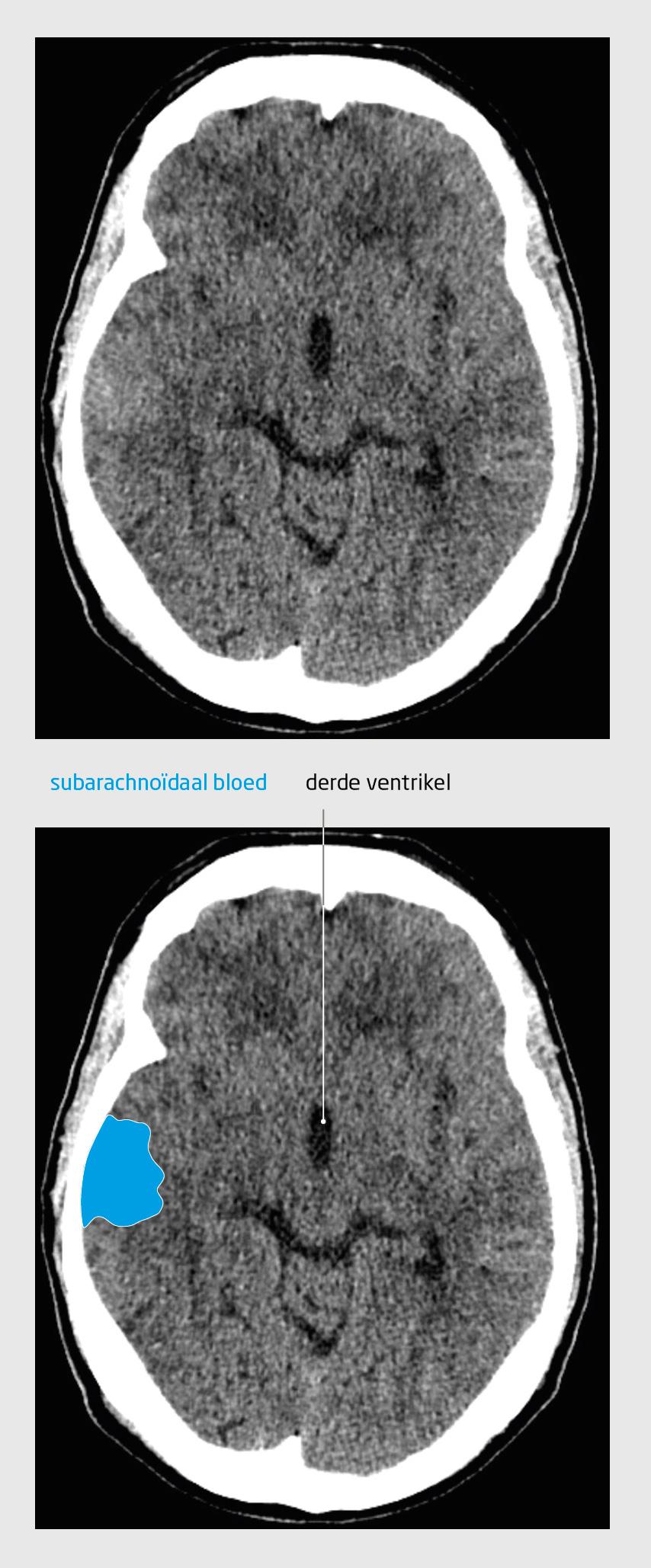 Figuur 2 | Subarachnoïdale bloeding | CT-scan van de hersenen van patiënt B