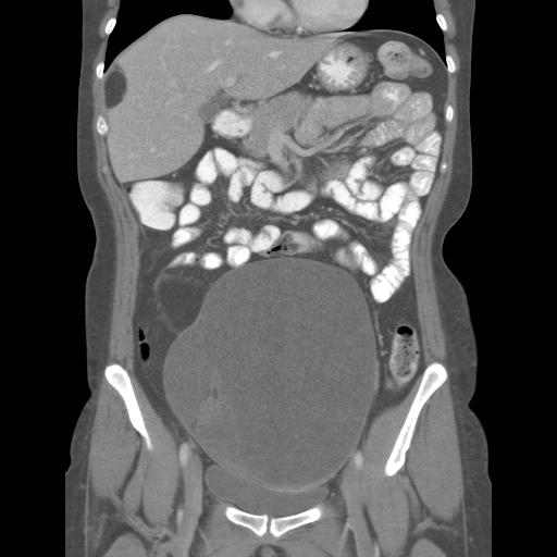 CT-scan van het abdomen van patiënte in coronale doorsnede