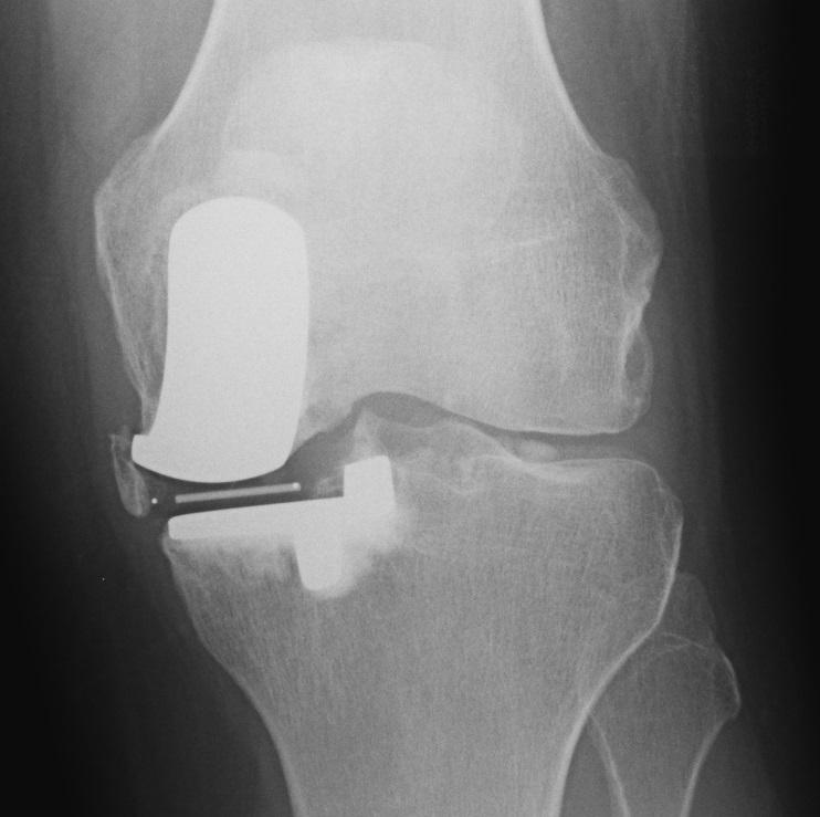 AP-röntgenfoto van de linker knie