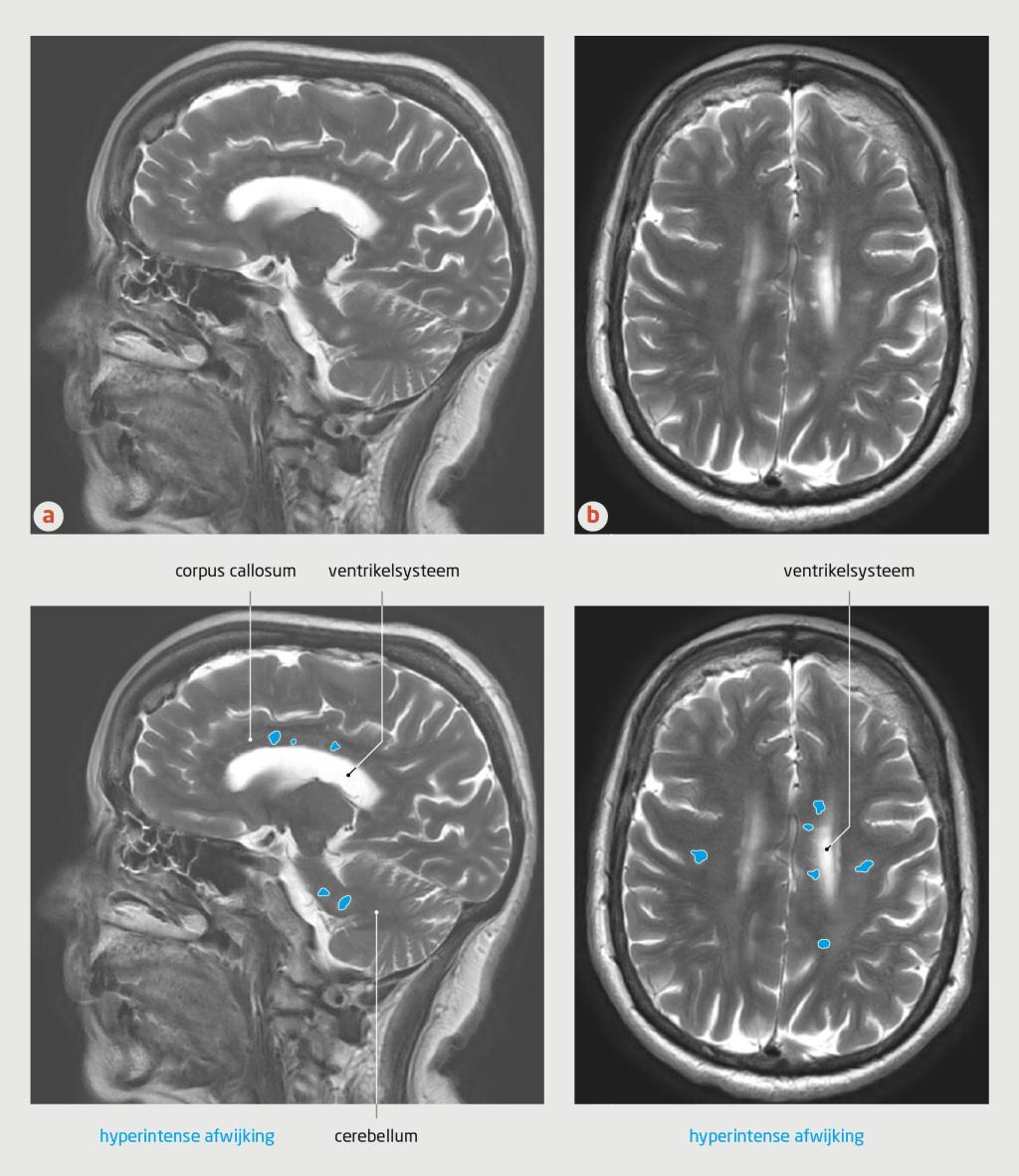 Figuur 1 | T2-gewogen MRI-opnames van de hersenen van de patiënte.