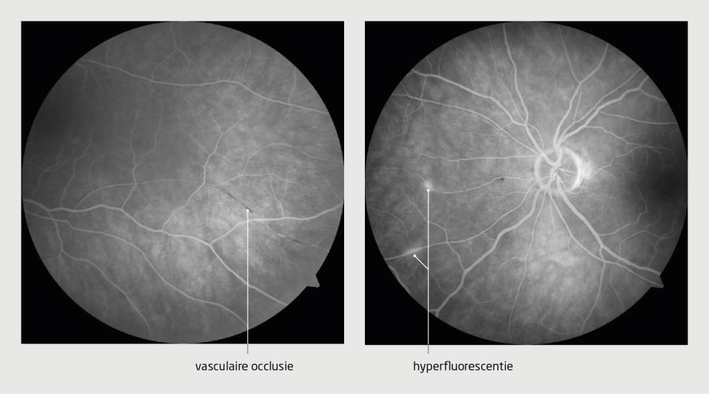 Figuur 2 | Retinale afwijkingen bij de patiënte met het syndroom van Susac