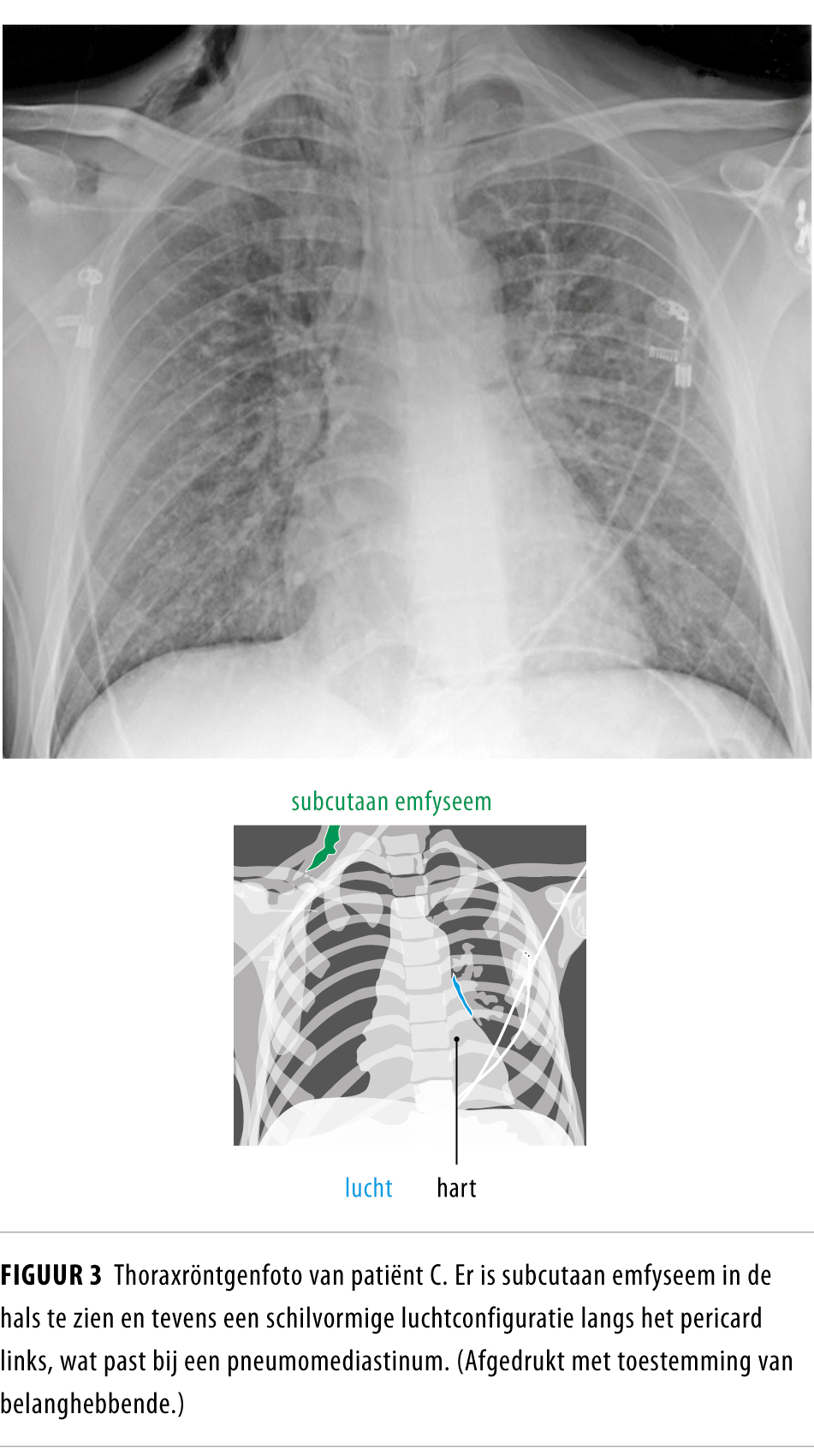 Pneumomediastinum ingrijpen is niet altijd vereist Nederlands
