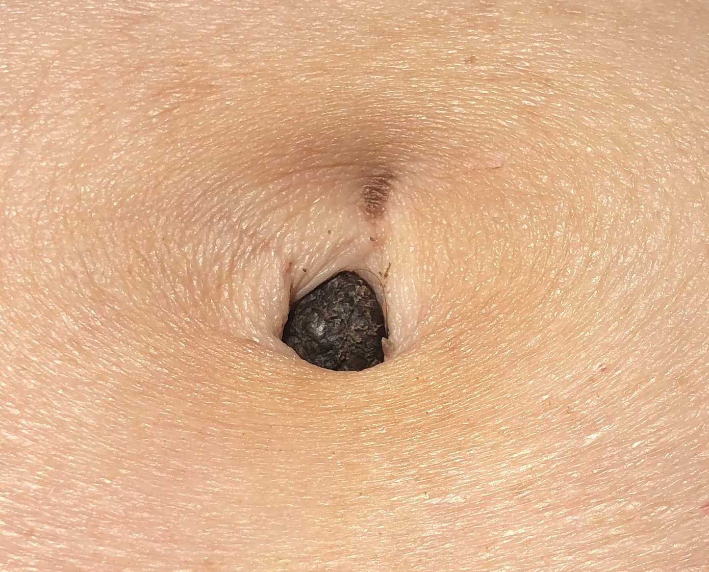 Vrouw Met Een Nodus In De Navel Nederlands Tijdschrift Voor Geneeskunde