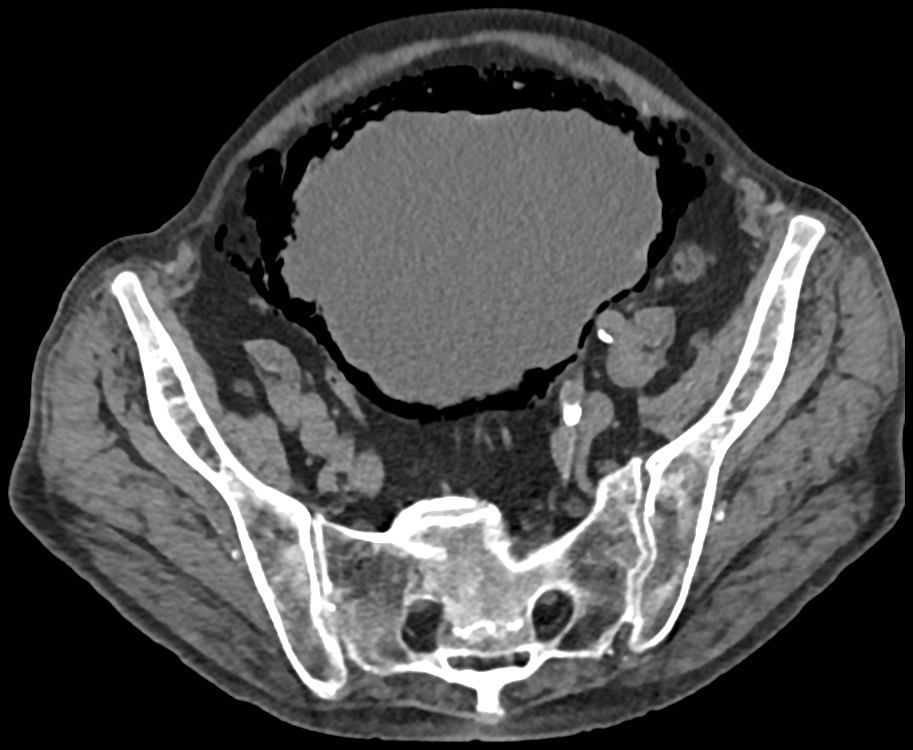 Flebolieten In Het Kleine Bekken