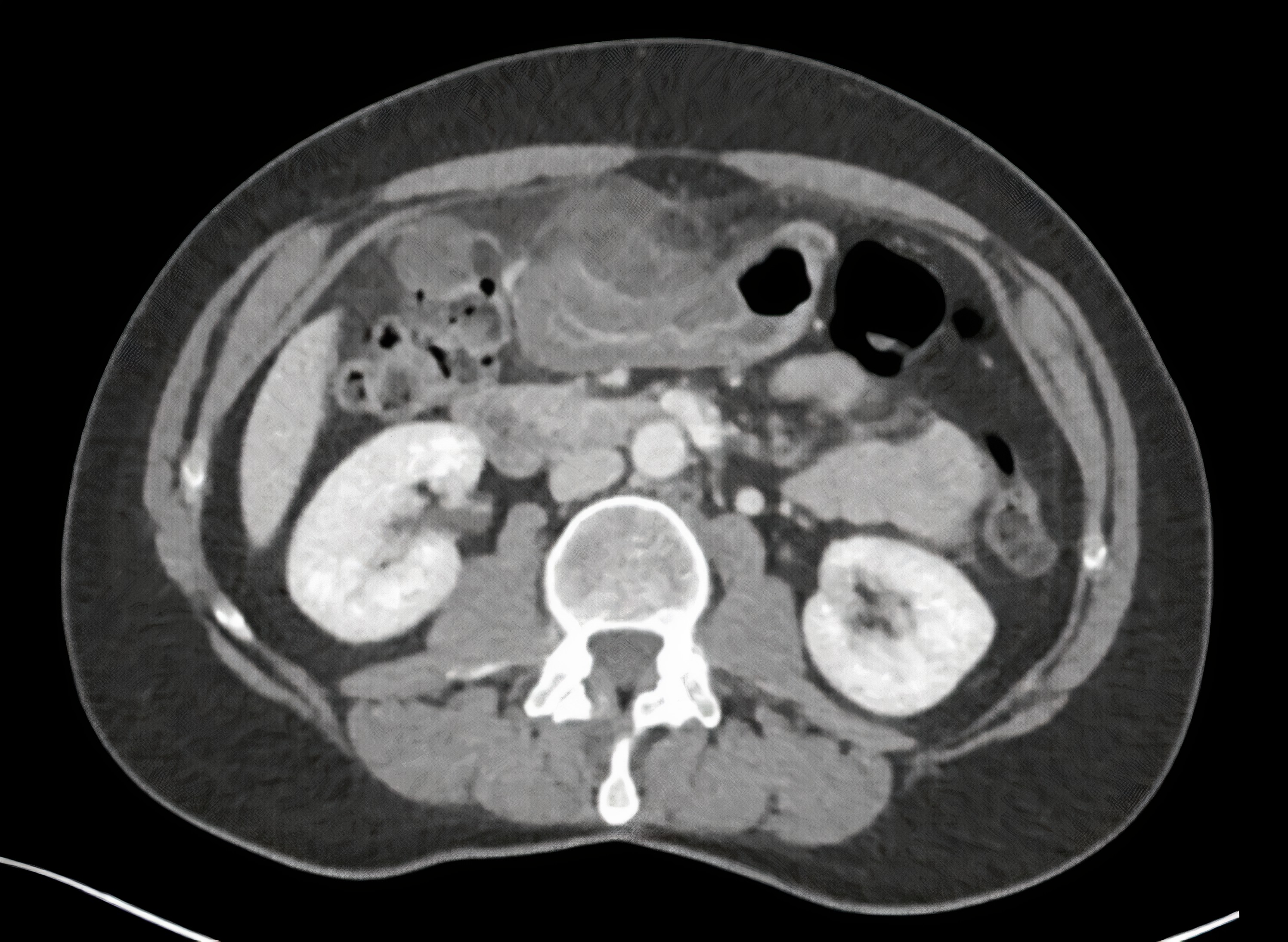 Pijn in de bovenbuik | Nederlands Tijdschrift voor Geneeskunde