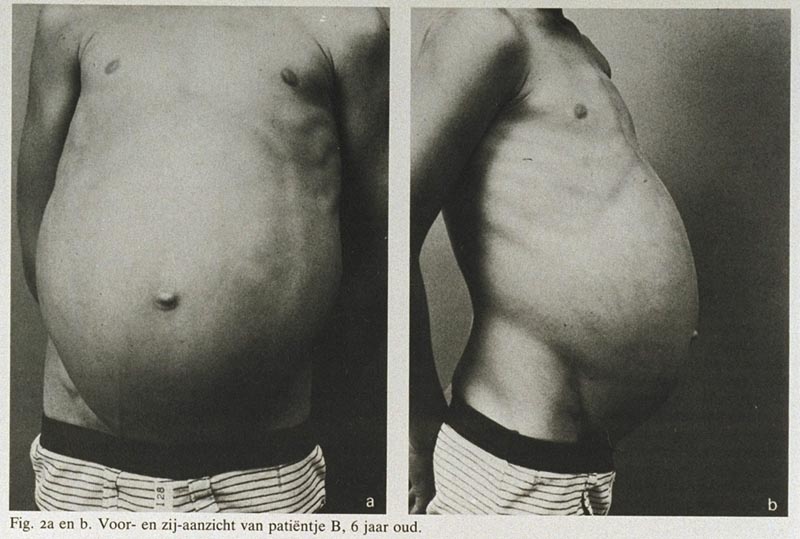 Het mesenteriale, omentale en retroperitoneale kystische lymfangioom