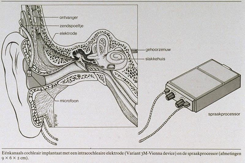 Cochleaire implantaten | Nederlands Tijdschrift voor Geneeskunde