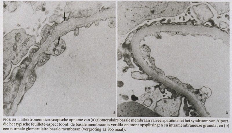 Het Syndroom Van Alport Nederlands Tijdschrift Voor Geneeskunde
