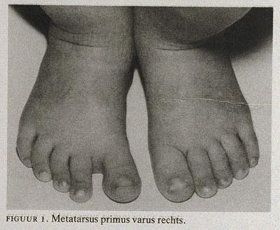 gezagvoerder Saga toxiciteit Aangeboren standafwijkingen van de voet bij kinderen | Nederlands  Tijdschrift voor Geneeskunde