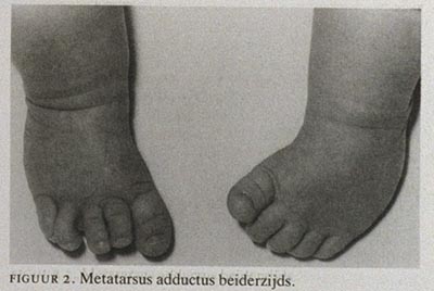 gezagvoerder Saga toxiciteit Aangeboren standafwijkingen van de voet bij kinderen | Nederlands  Tijdschrift voor Geneeskunde