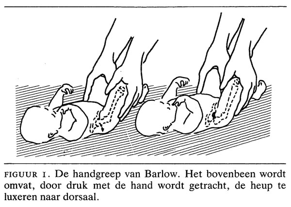 Congenitale Heupluxatie Oorzaken En Gevolgen Van Late Diagnose Nederlands Tijdschrift Voor Geneeskunde