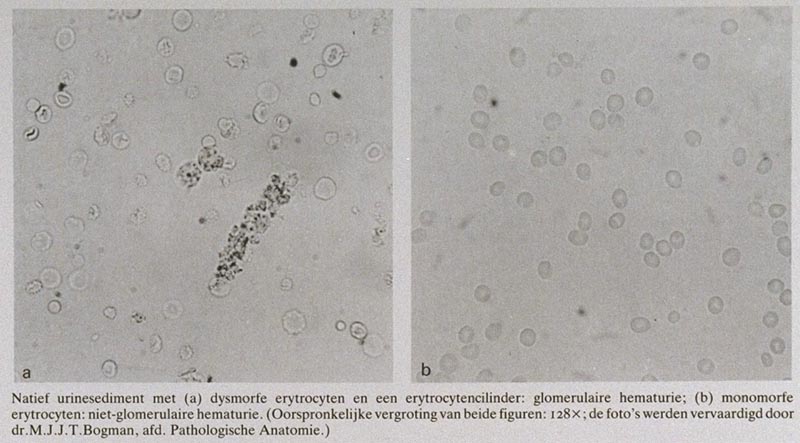 Het urinesediment bij pijnloze hematurie: een ondergewaardeerd