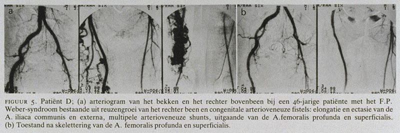 Congenitale angiodysplasie van de ledematen; diagnose en therapie