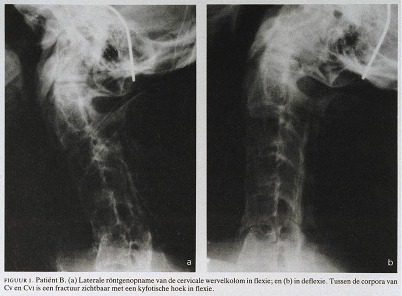 Een gevaarlijk stijve nek bij ziekte van Bechterew Nederlands Tijdschrift voor Geneeskunde
