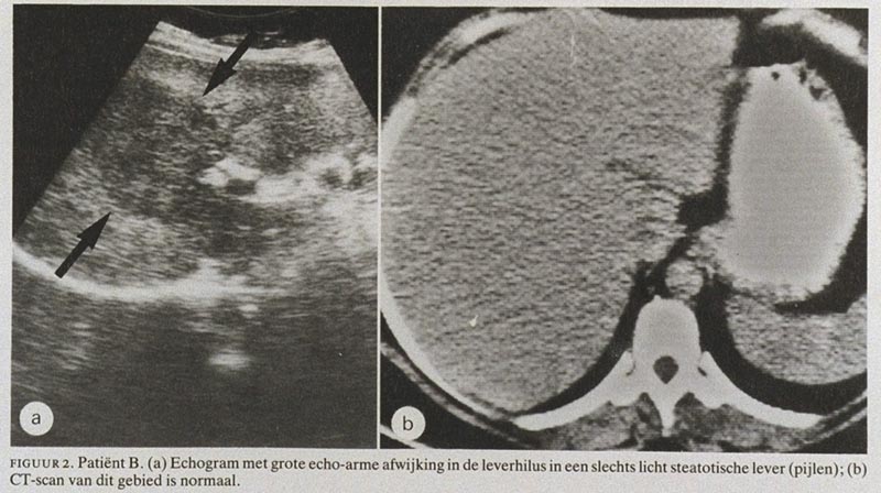 Echografie bij focale non-steatose van de lever; diagnostische