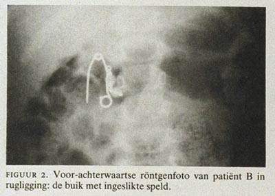 Baby ingeslikt houtsnippers