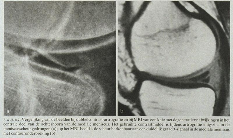 De waarde van kernspinresonantie-tomografie bij de diagnostiek van