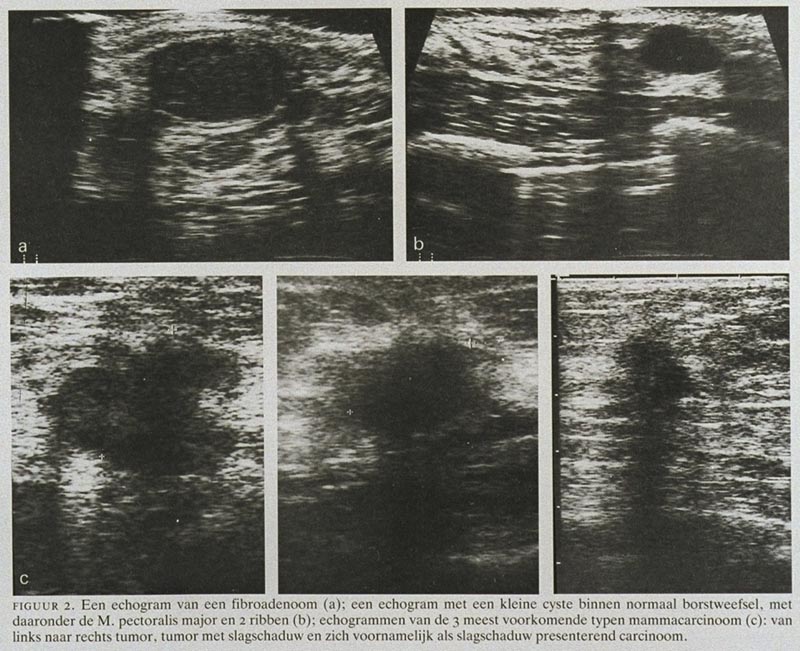 Echografie is van belang als aanvullend onderzoek bij mammografie