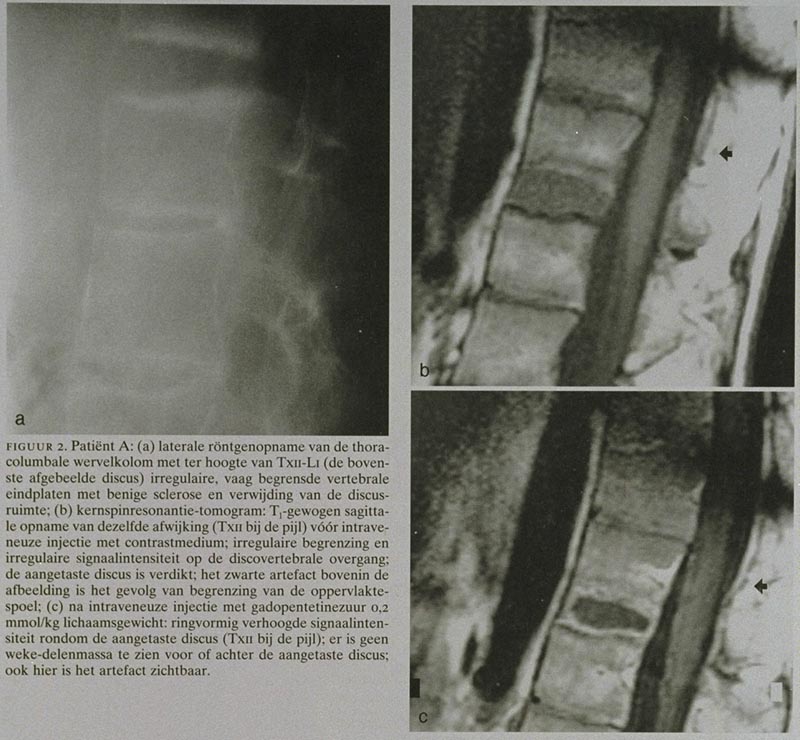 Spondylodiscitis bij de ziekte van Bechterew; ontsteking of trauma? Een