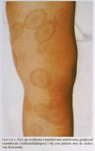 Exanthemen bij kinderen | Nederlands Tijdschrift voor