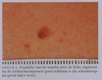 Dysplastische naevi en het risico op melanoom: een richtlijn voor ...