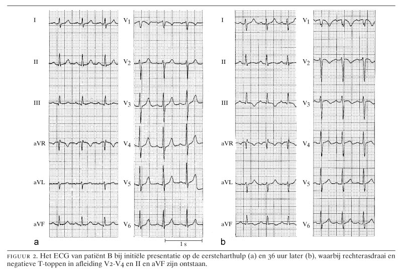 Pijn op de borst en afwijkend elektrocardiogram: denk aan longembolie