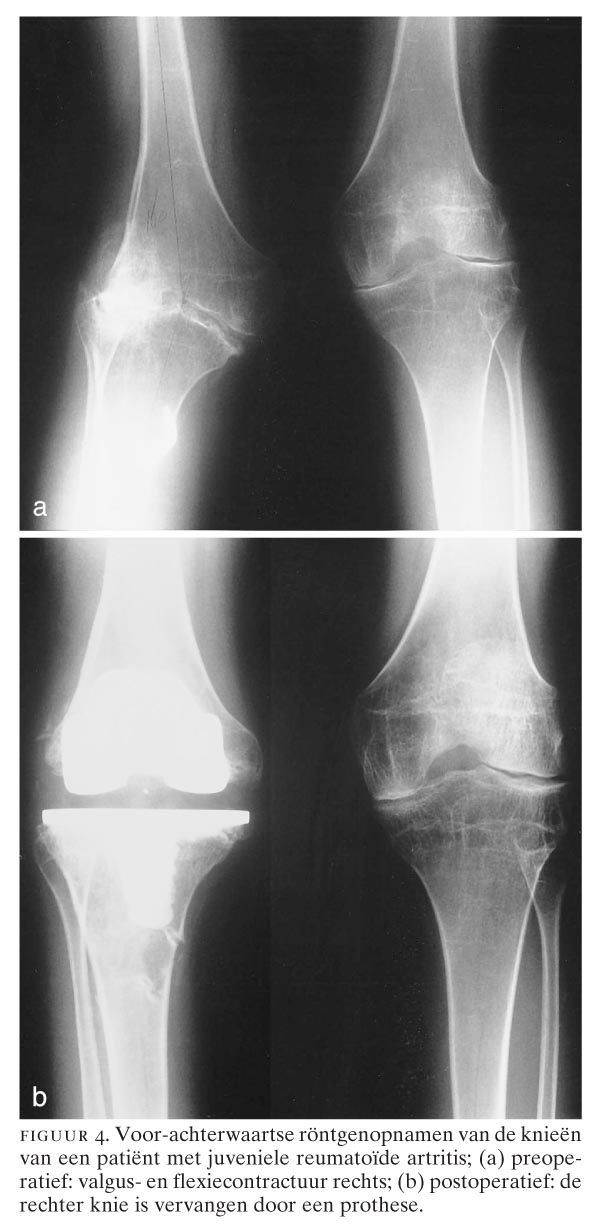 Honderd Jaar Orthopedie In Nederland Vi Reumachirurgie Nederlands Tijdschrift Voor Geneeskunde
