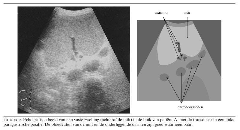 Een wandelende milt | Nederlands Tijdschrift voor Geneeskunde