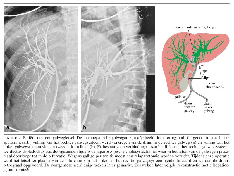 Galwegletsel na laparoscopische cholecystectomie Nederlands Tijdschrift voor Geneeskunde