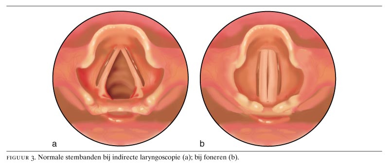 Laryngitis chronische Kehlkopfentzündung