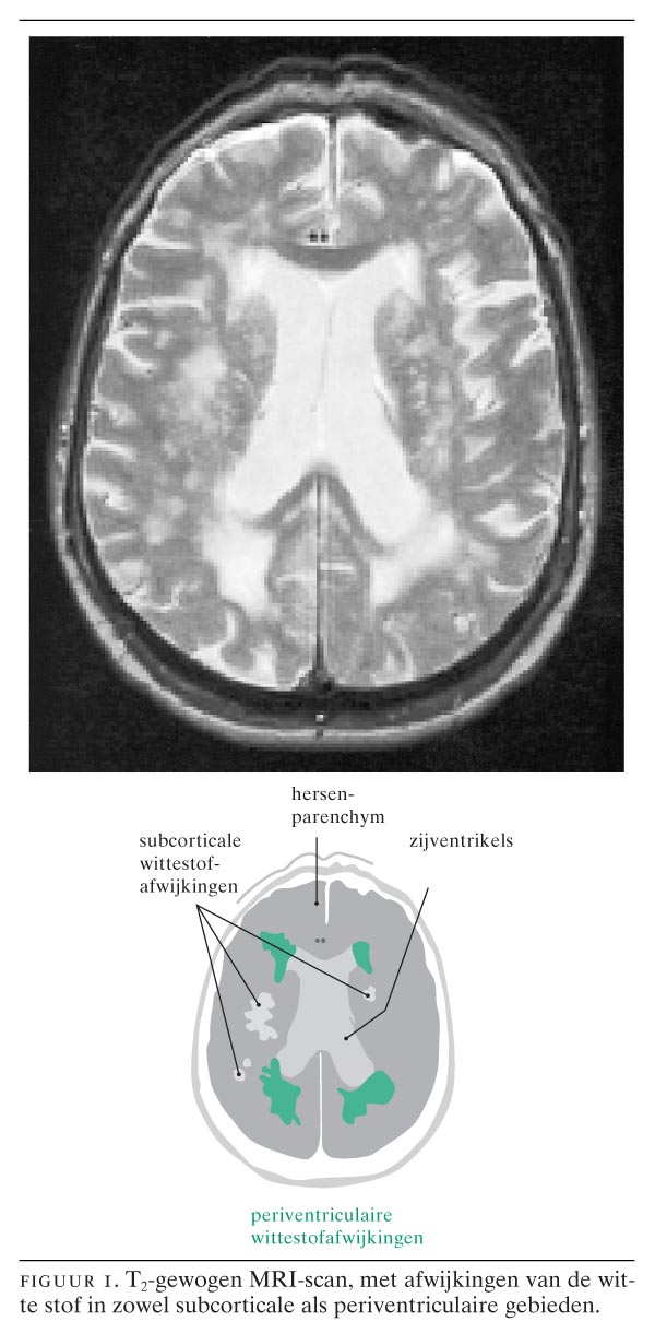 Wittestofafwijkingen in de hersenen bij ouderen