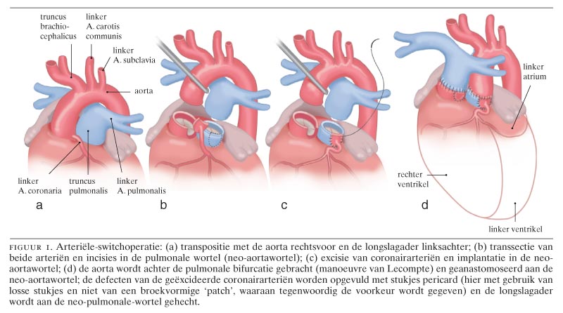 Arteriële-switchoperatie bij transpositie van de grote vaten; gunstige