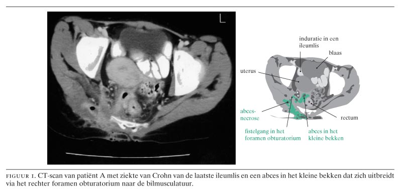 Gluteale abcessen gecompliceerd door sepsis als uiting van de ziekte
