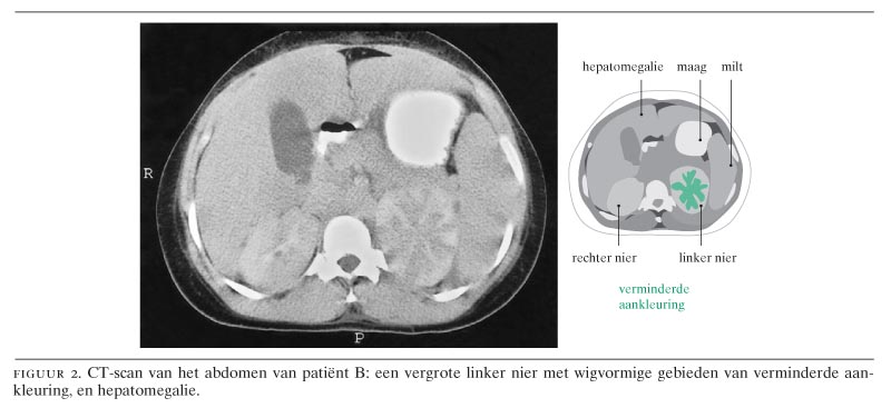 Het syndroom van Fitz-Hugh-Curtis: 2 patiëntes met perihepatitis en ook