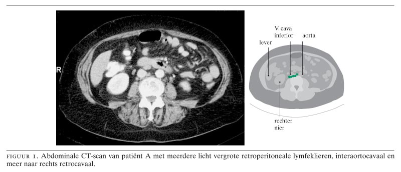 Ct Scan Vergrote Lymfeklier Buik