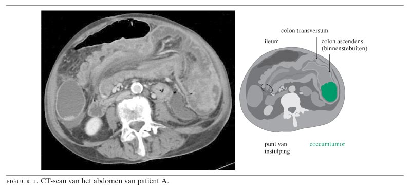 Onbegrepen vage buikklachten bij volwassenen: bij vermoeden van een