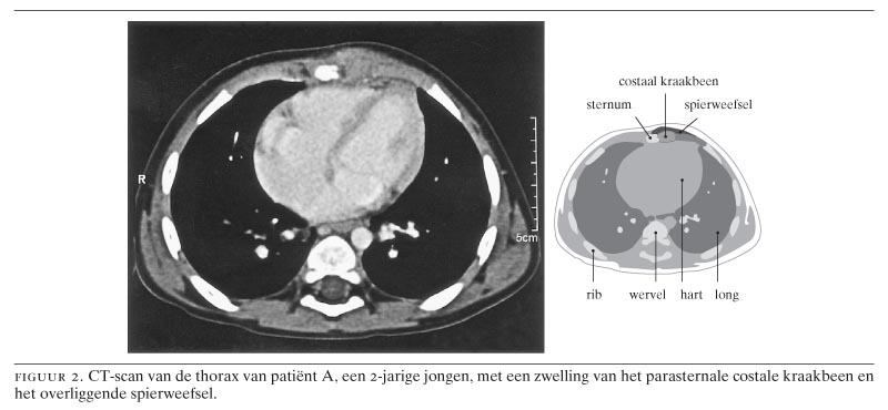 Het syndroom van Tietze bij een 2-jarige jongen | Nederlands