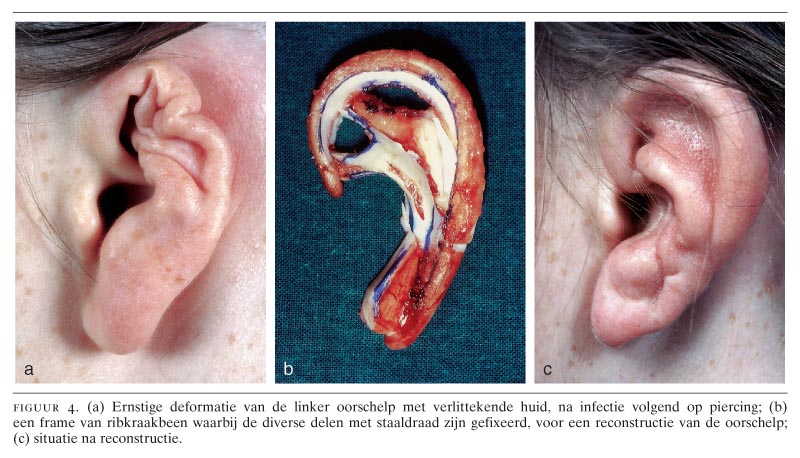 3 Patienten Met Complicaties Als Gevolg Van Piercing Van Het Oorkraakbeen Nederlands Tijdschrift Voor Geneeskunde
