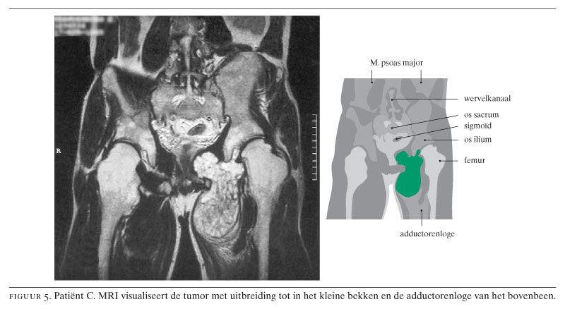 Drie patiënten met hereditaire multipele exostosen en maligne