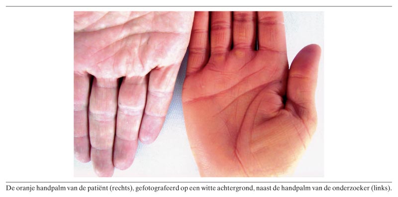 Manifesteren Resistent versnelling Diagnose in beeld (207). Een vrouw met oranje handen | NTvG