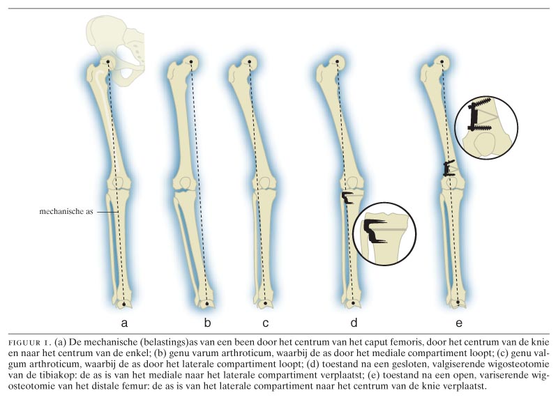 Osteocondroza genunchiului 3 grade artroza și subluxație a umărului comun