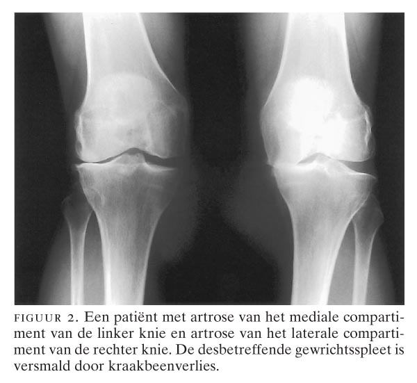 deteriorarea ligamentelor interne ale genunchiului cum se tratează articulațiile din brațe