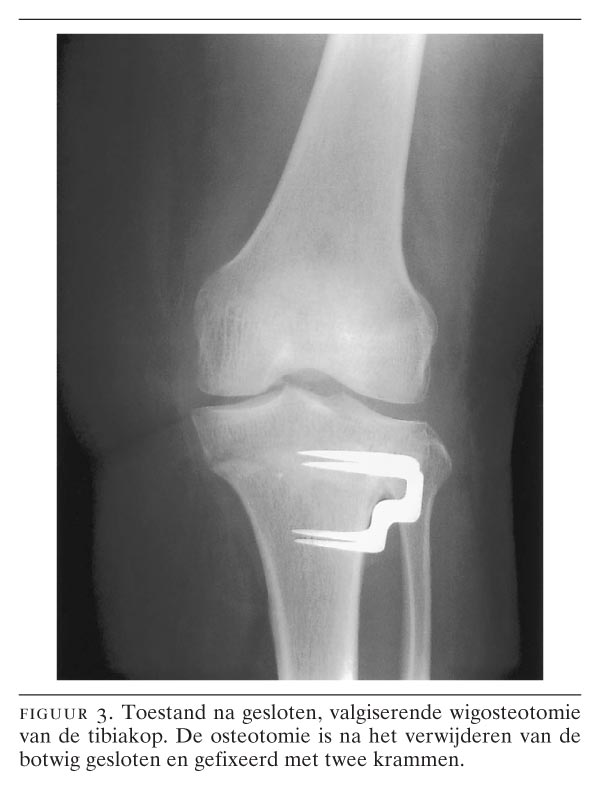 doorboren stap in kiezen Osteotomie ter hoogte van de knie voor jonge patiënten met gonartrose | NTvG