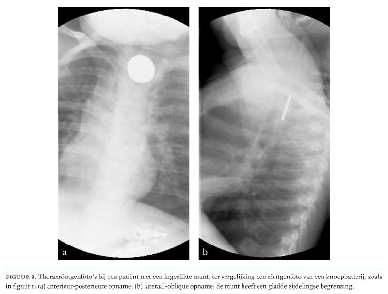 Gefährte Feuchtigkeit Solidarität knoopcel batterij ingeslikt