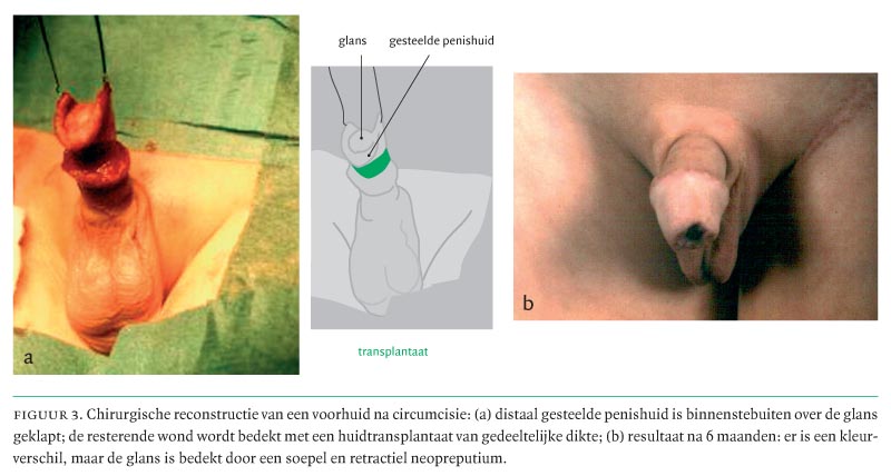 Procedure dorsal slit Dorsal Slit
